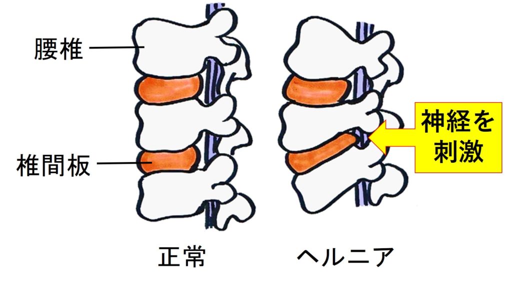 正常な背骨とヘルニアになった背骨