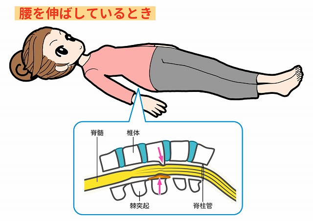 脊柱管狭窄症と姿勢の関係