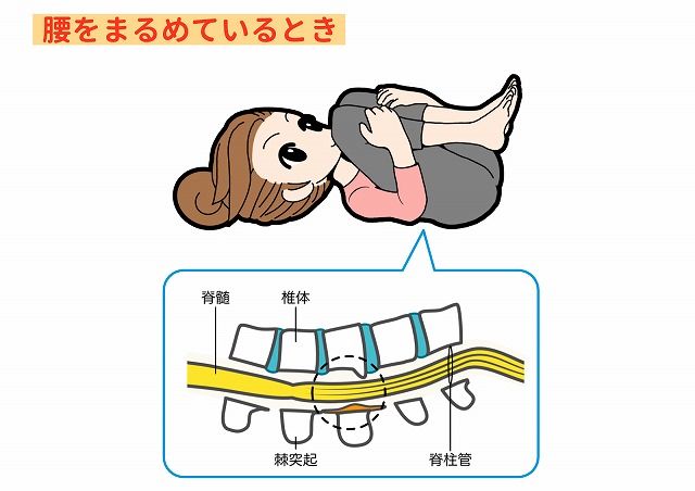 脊柱管狭窄症と姿勢の関係、痛みが出ない姿勢