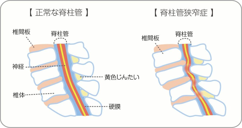 脊柱管狭窄症と健康な背骨の図