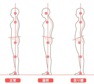 猫背、反り腰、正常な姿勢の比較