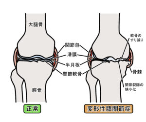 変形性膝関節症と正常な膝