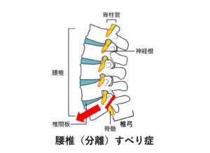 腰椎(分離)すべり症