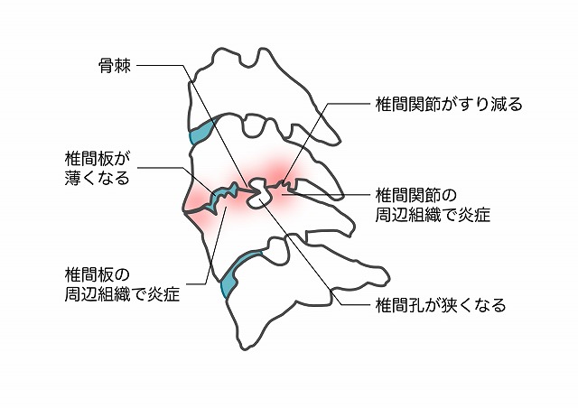 頚椎症のイメージ画像