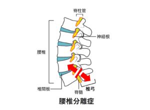 腰椎分離症