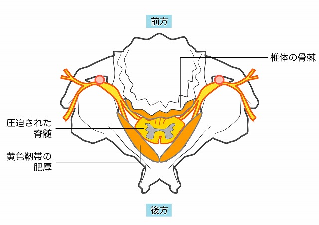 頚椎症性脊髄症の頸椎の断面