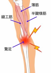 鵞足炎、薄筋、半腱様筋、縫工筋