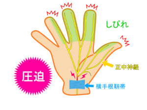 手根管症候群で指にしびれが出る様子