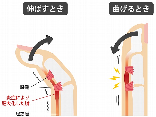 ばね指のメカニズム