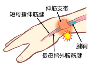 腱鞘炎（ドケルバン病）のメカニズム